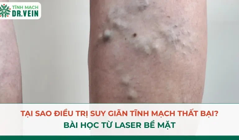 Tại Sao Điều Trị Suy Giãn Tĩnh Mạch Thất Bại? Bài Học Từ Laser Bề Mặt Tại Sao Điều Trị Suy Giãn Tĩnh Mạch Thất Bại? Bài Học Từ Laser Bề Mặt