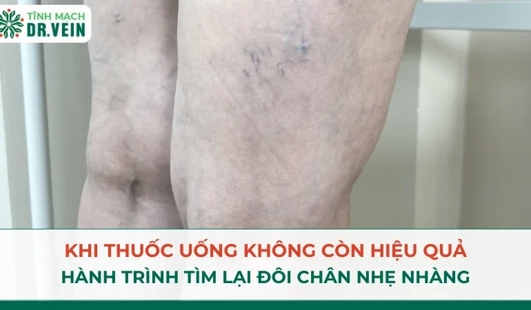 Điều Trị Suy Giãn Tĩnh Mạch: Kết Quả Tích Cực Sau 1 Tháng Điều Trị Suy Giãn Tĩnh Mạch: Kết Quả Tích Cực Sau 1 Tháng
