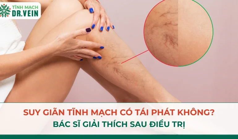 Suy Giãn Tĩnh Mạch Có Tái Phát Không? Bác Sĩ Giải Thích Sau Điều Trị Suy Giãn Tĩnh Mạch Có Tái Phát Không? Bác Sĩ Giải Thích Sau Điều Trị
