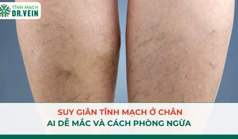 Suy Giãn Tĩnh Mạch Ở Chân: Ai Dễ Mắc Và Cách Phòng Ngừa
