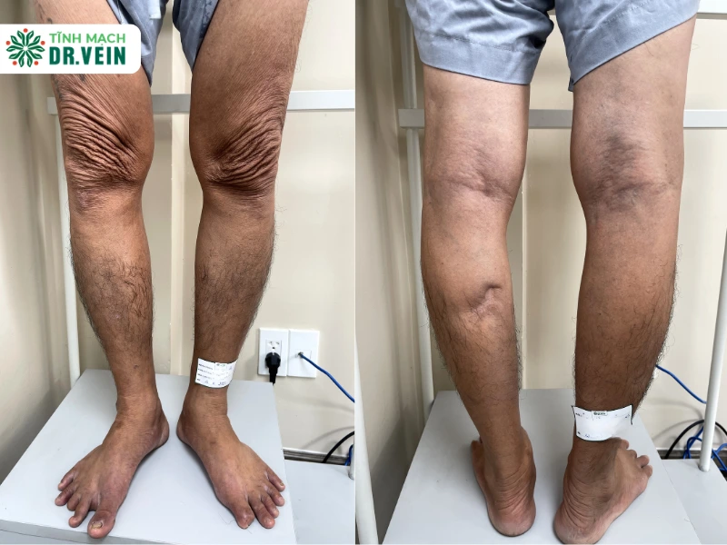 Tình Trạng Ban Đầu: Triệu Chứng Chồng Chéo Trên Nền Bệnh Lý Phức Tạp
