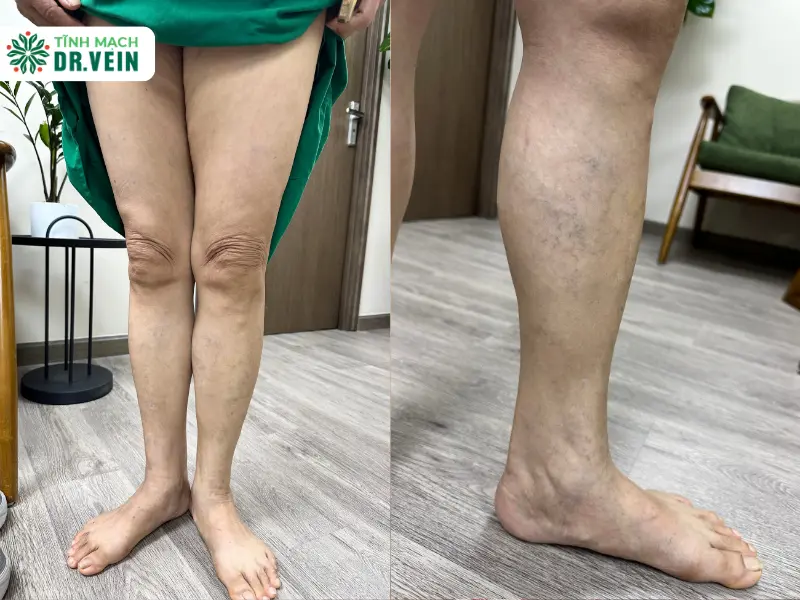 Phác Đồ Giải Quyết Phù Hợp Cho Các Nhánh Tĩnh Mạch Mới Suy Yếu