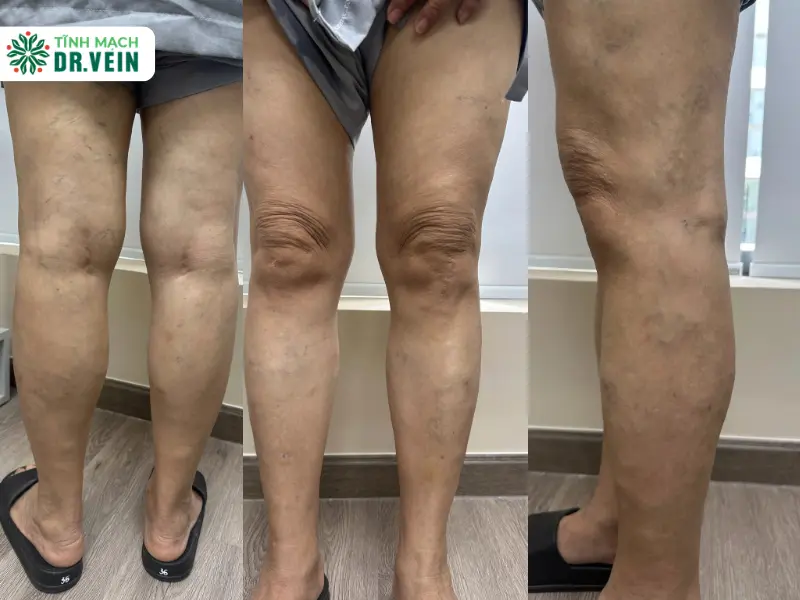 Tình Trạng Ban Đầu: Cơn Nhức Mỏi Quay Trở Lại Sau Hơn 1 Năm