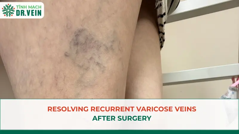 Resolving Recurrent Varicose Veins After Surgery
