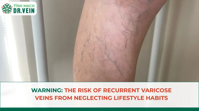 Warning: The Risk Of Recurrent Varicose Veins From Neglecting Lifestyle Habits