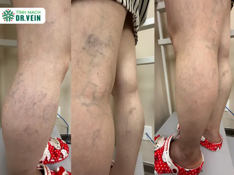 Giải Quyết Tình Trạng Tái Phát Suy Tĩnh Mạch Sau Phẫu Thuật Phân Tích Lâm Sàng Ca Bệnh D.T.A.T. Tại Dr. Vein
