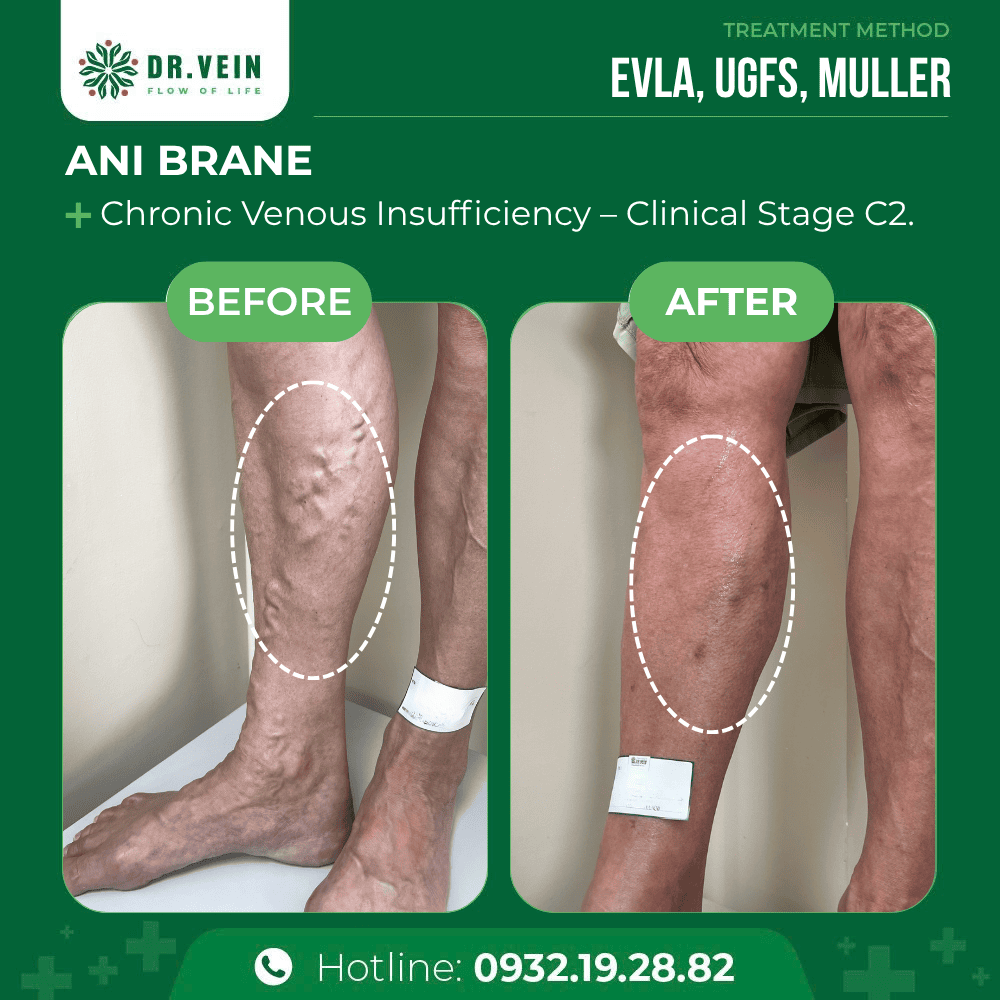 How EVLA, UGFS, And Muller Restored Leg Health For A 68-Year-Old Canadian Patient