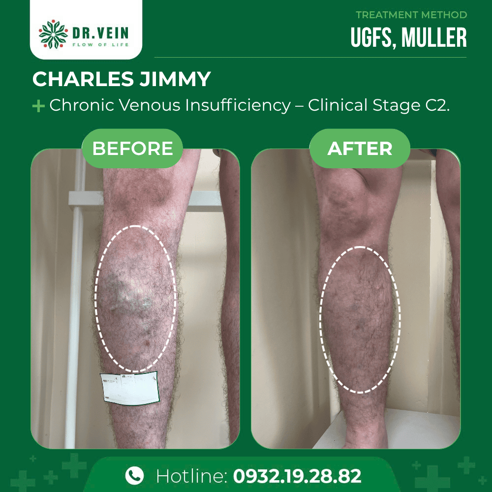 Treating Bulging Veins On Lower Legs: A 10-Year Journey To Restored Leg Health For Charles Jimmy