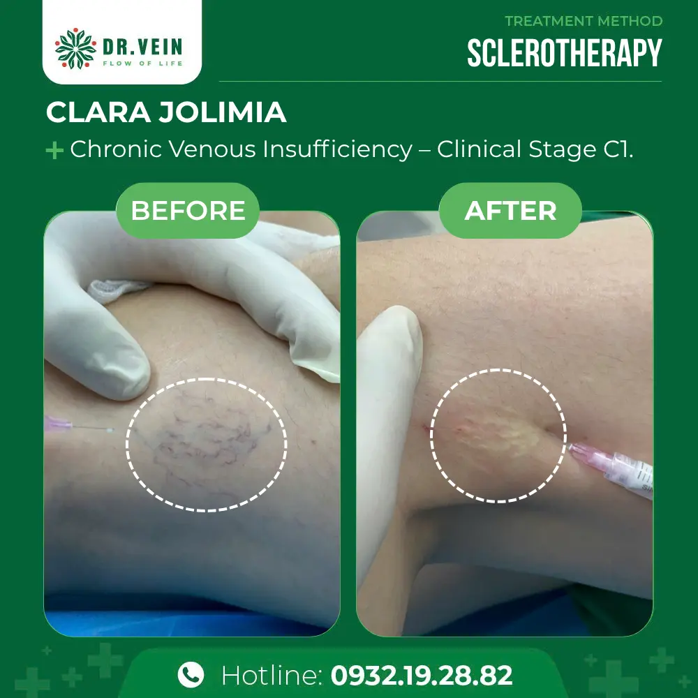 Treating Postpartum Varicose Veins: Clara Jolimia’s Journey To Restored Leg Health At Dr. Vein