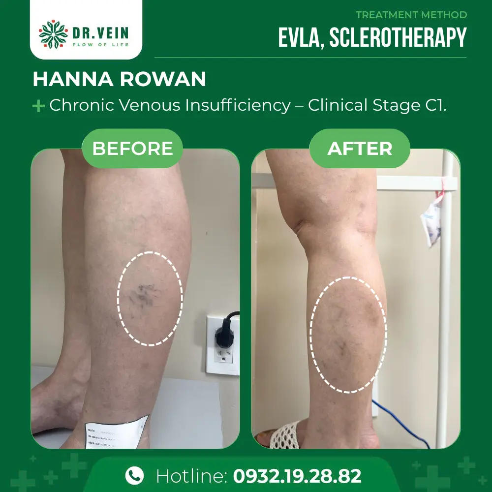 Eliminating Blue And Purple Spider Veins: Hanna Rowan’s Journey To Healthy Legs At Dr. Vein