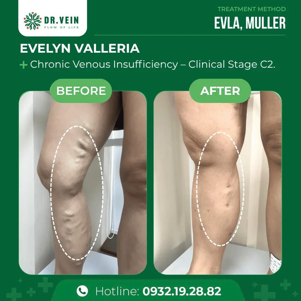 Overcoming Severe Bulging Veins And Leg Aching: Evelyn Valleria’s Treatment Journey At Dr. Vein