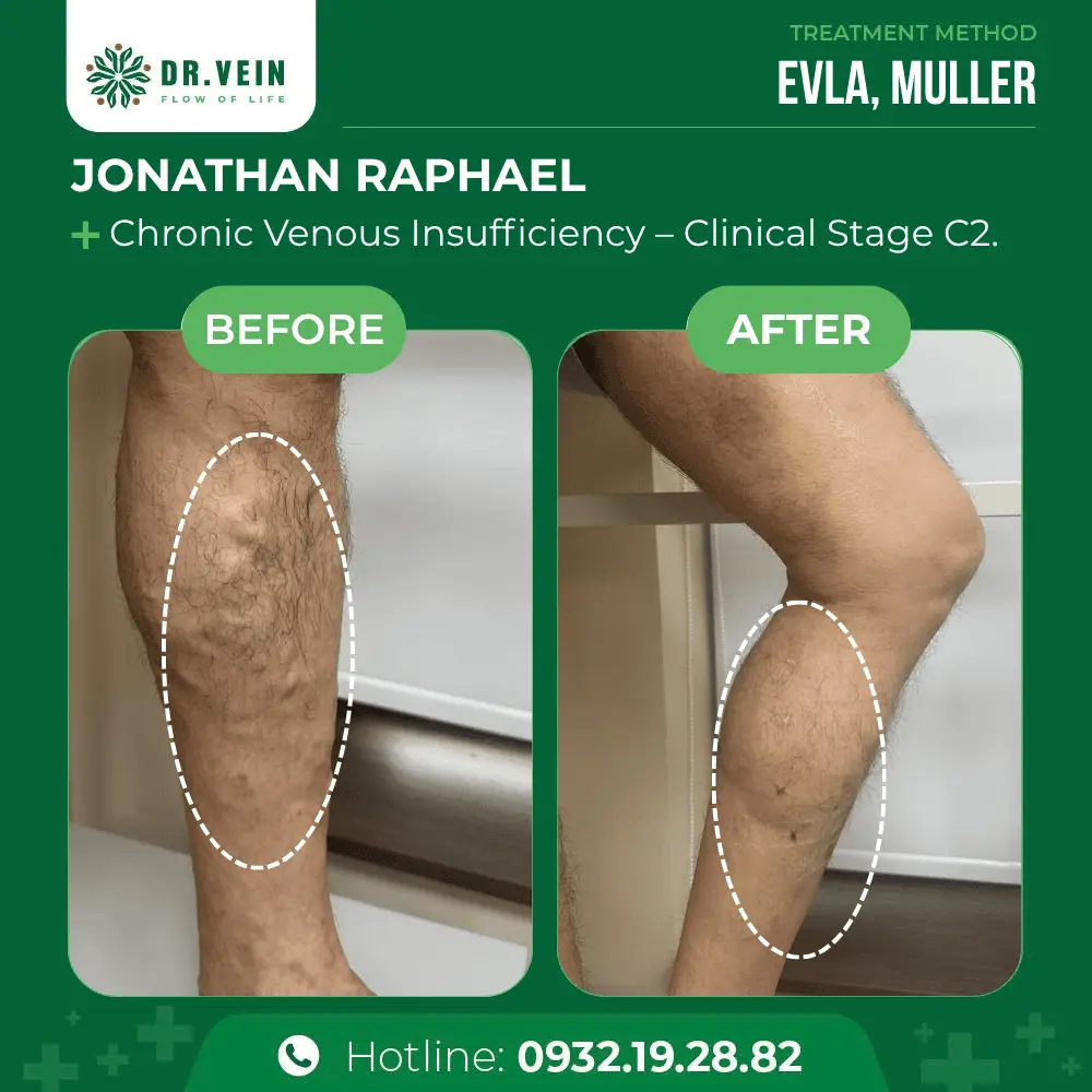 Treating Asymptomatic Bulging Varicose Veins: Jonathan Raphael’s Story At Dr. Vein