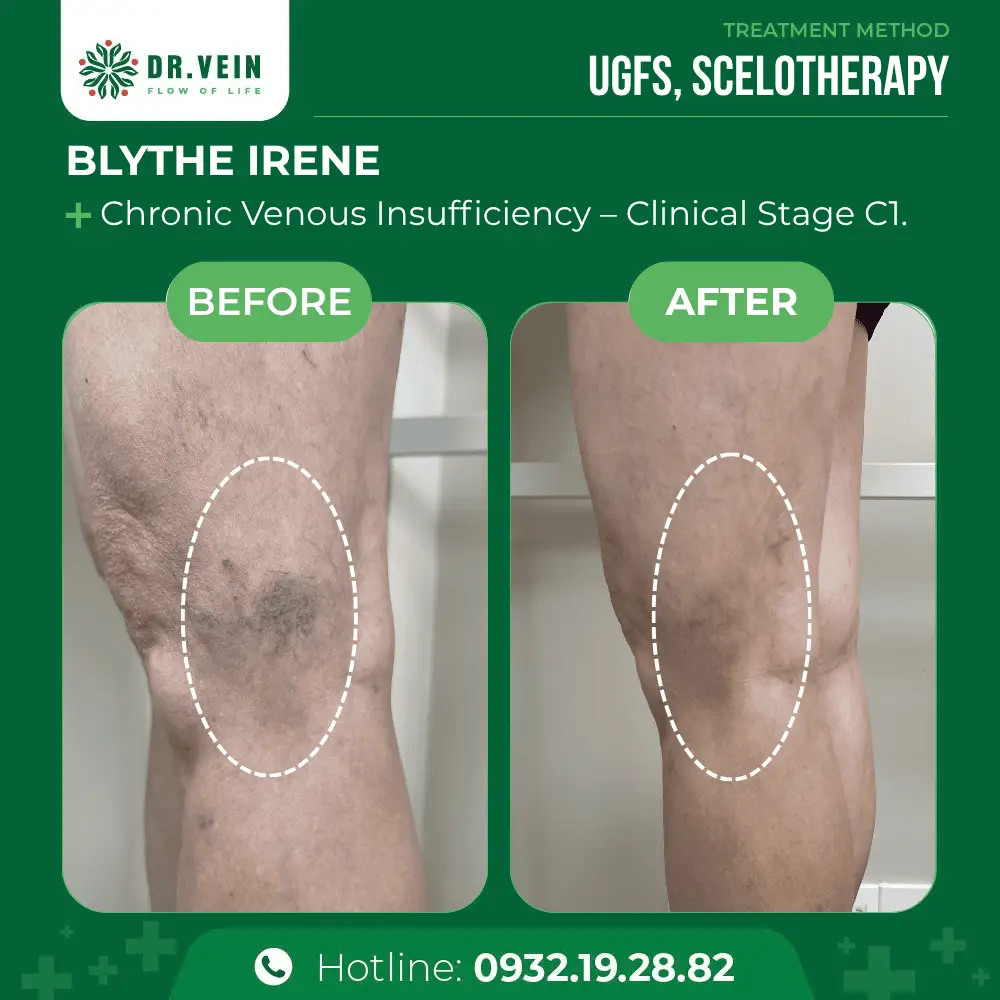 Over 10 Years Unaddressed: Blythe Irene’s Journey To Treating Cosmetic Spider Veins At Dr. Vein