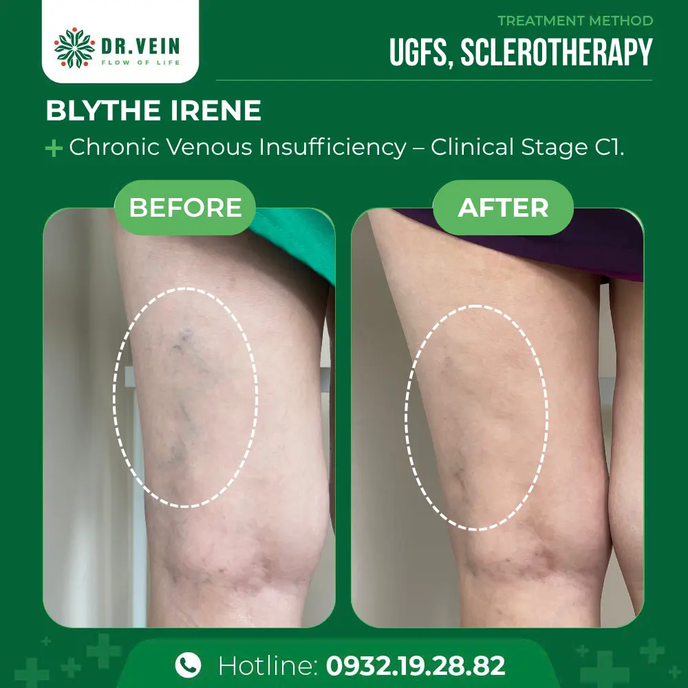 Over 10 Years Unaddressed: Blythe Irene’s Journey To Treating Cosmetic Spider Veins At Dr. Vein Over 10 Years Unaddressed: Blythe Irene’s Journey To Treating Cosmetic Spider Veins At Dr. Vein