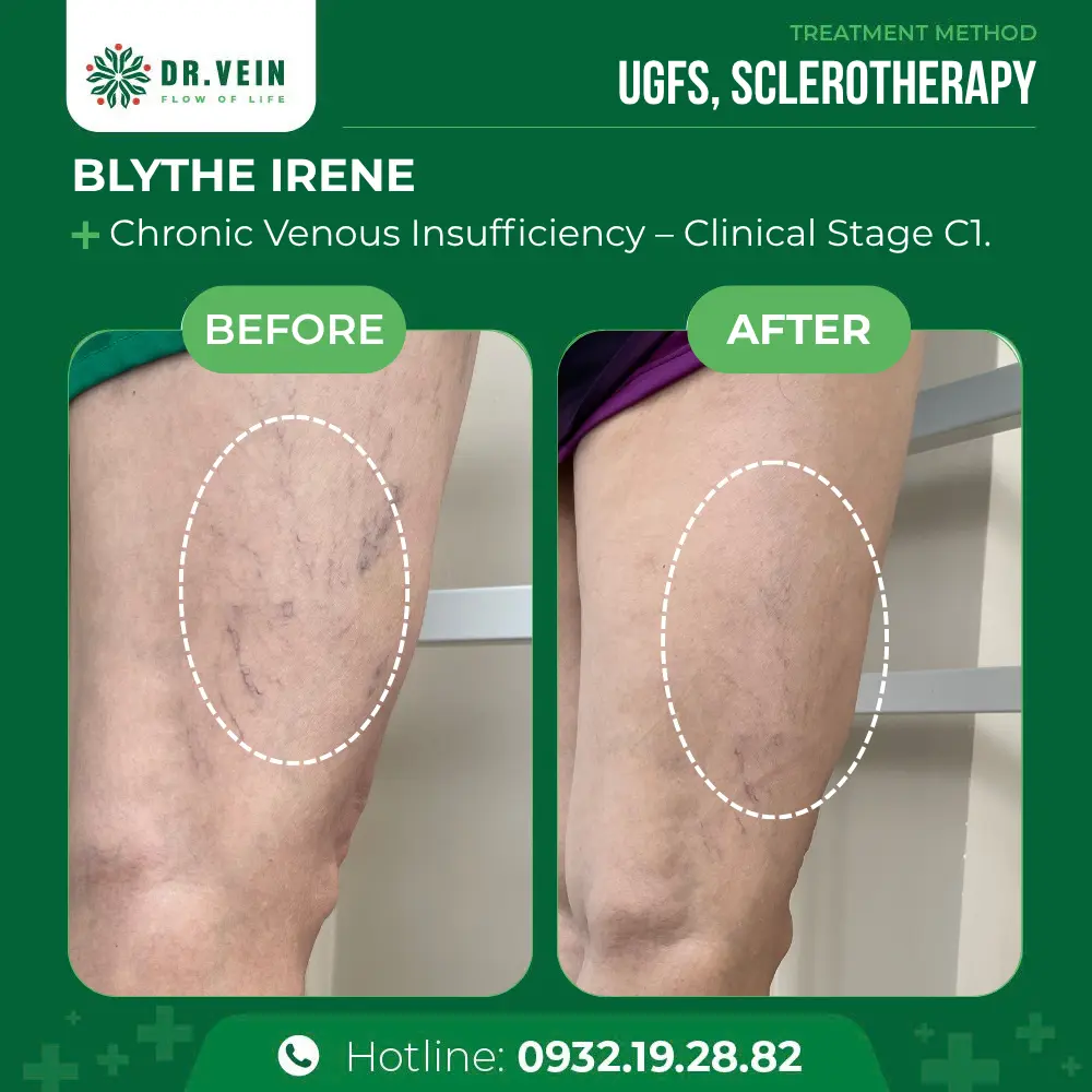 Over 10 Years Unaddressed: Blythe Irene’s Journey To Treating Cosmetic Spider Veins At Dr. Vein