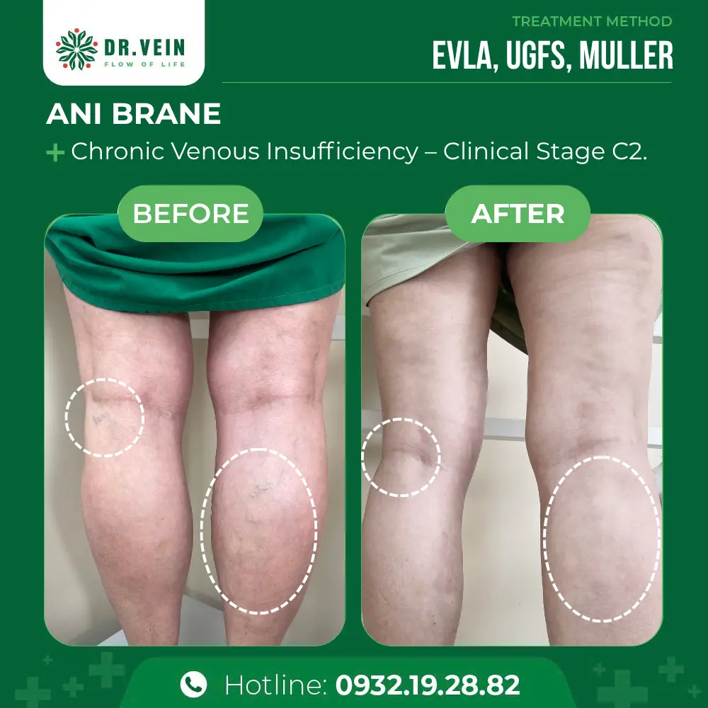 How EVLA, UGFS, And Muller Restored Leg Health For A 68-Year-Old Canadian Patient