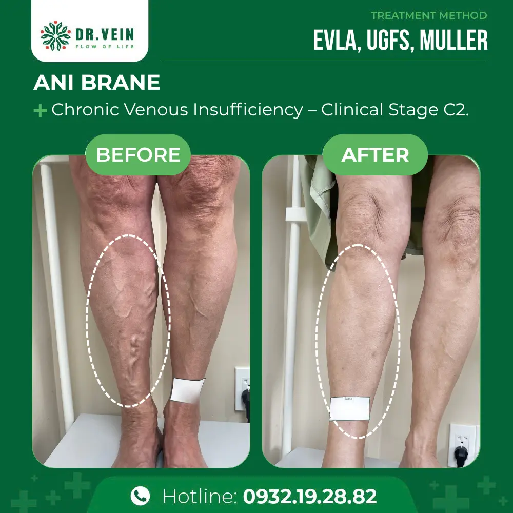 How EVLA, UGFS, And Muller Restored Leg Health For A 68-Year-Old Canadian Patient