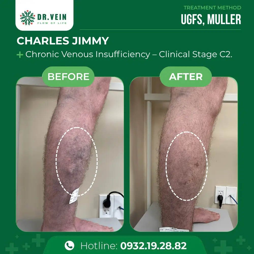 Treating Bulging Veins On Lower Legs: A 10-Year Journey To Restored Leg Health For Charles Jimmy