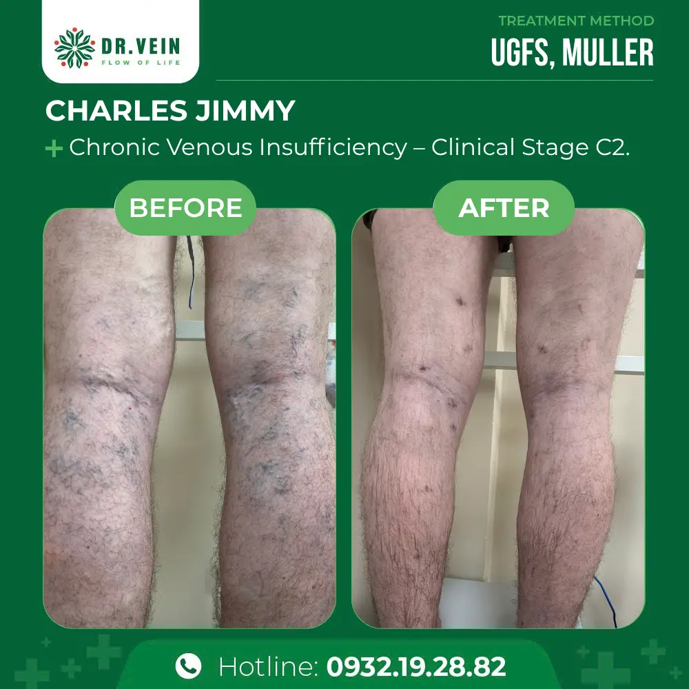 Treating Bulging Veins On Lower Legs: A 10-Year Journey To Restored Leg Health For Charles Jimmy
