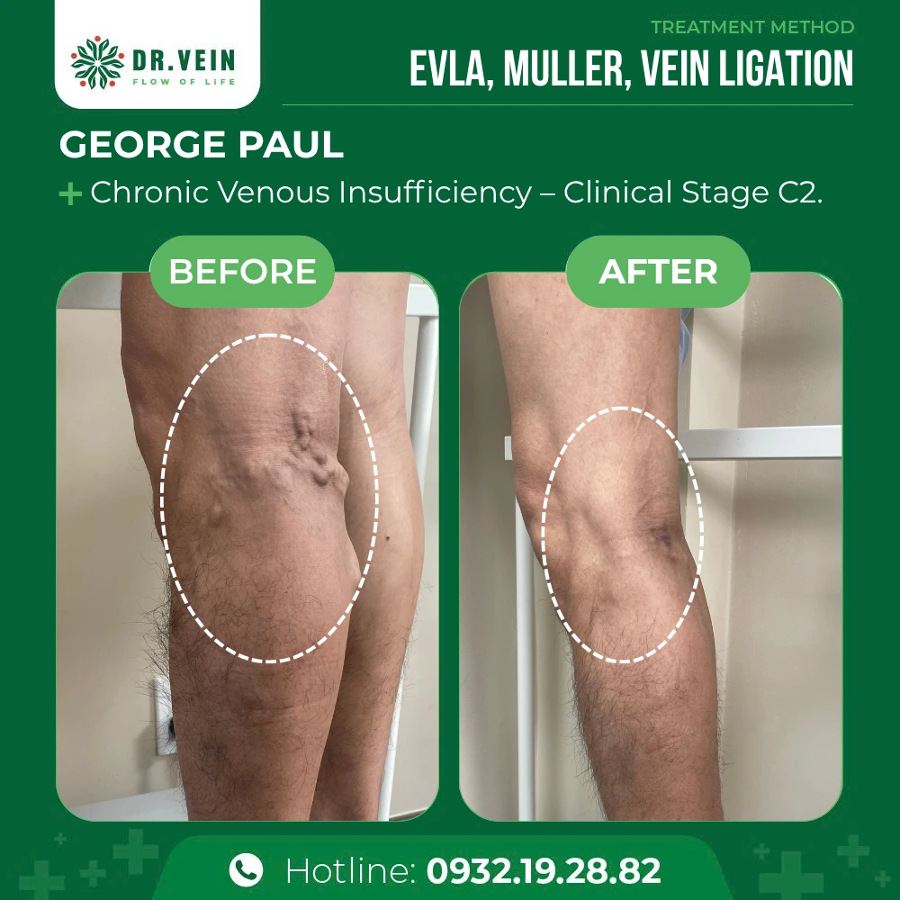 Relieving Long-Standing Leg Heaviness And Fatigue: George Paul’s Journey At Dr. Vein