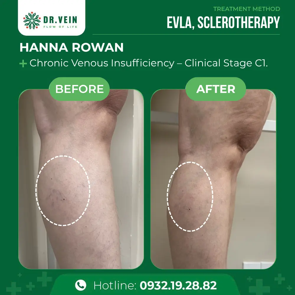 Eliminating Blue And Purple Spider Veins: Hanna Rowan’s Journey To Healthy Legs At Dr. Vein Eliminating Blue And Purple Spider Veins: Hanna Rowan’s Journey To Healthy Legs At Dr. Vein