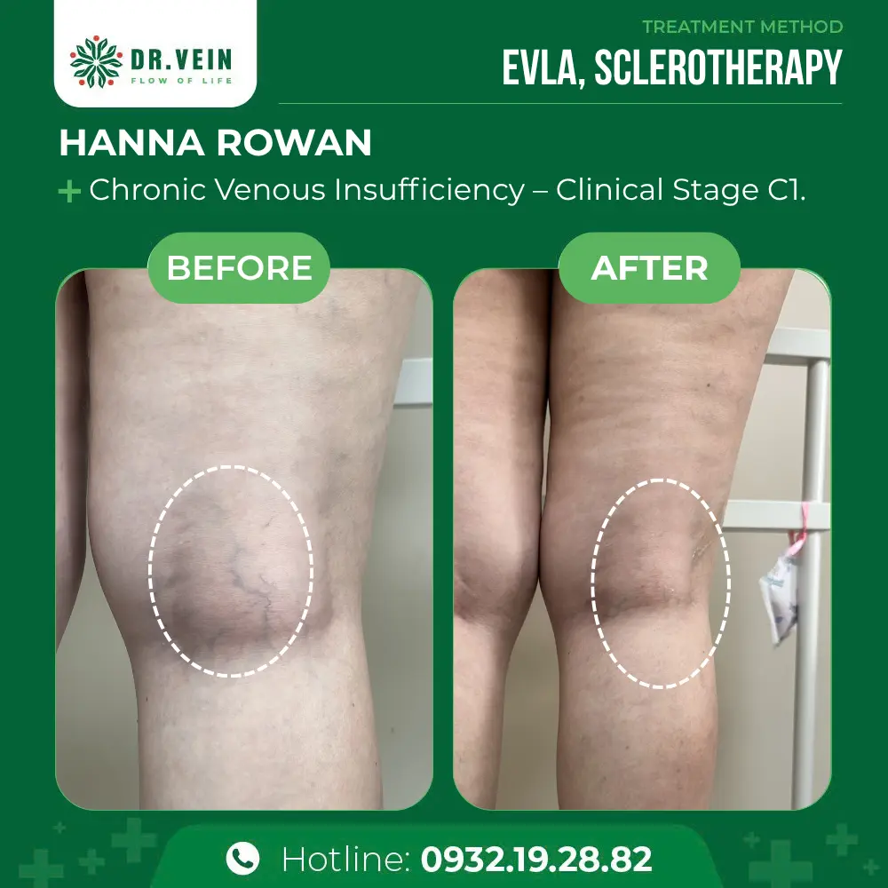Eliminating Blue And Purple Spider Veins: Hanna Rowan’s Journey To Healthy Legs At Dr. Vein