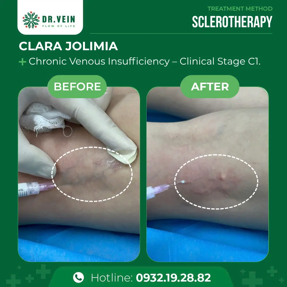 Treating Postpartum Varicose Veins: Clara Jolimia’s Journey To Restored Leg Health At Dr. Vein