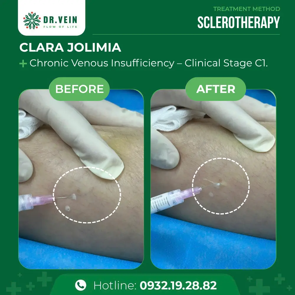 Treating Postpartum Varicose Veins: Clara Jolimia’s Journey To Restored Leg Health At Dr. Vein