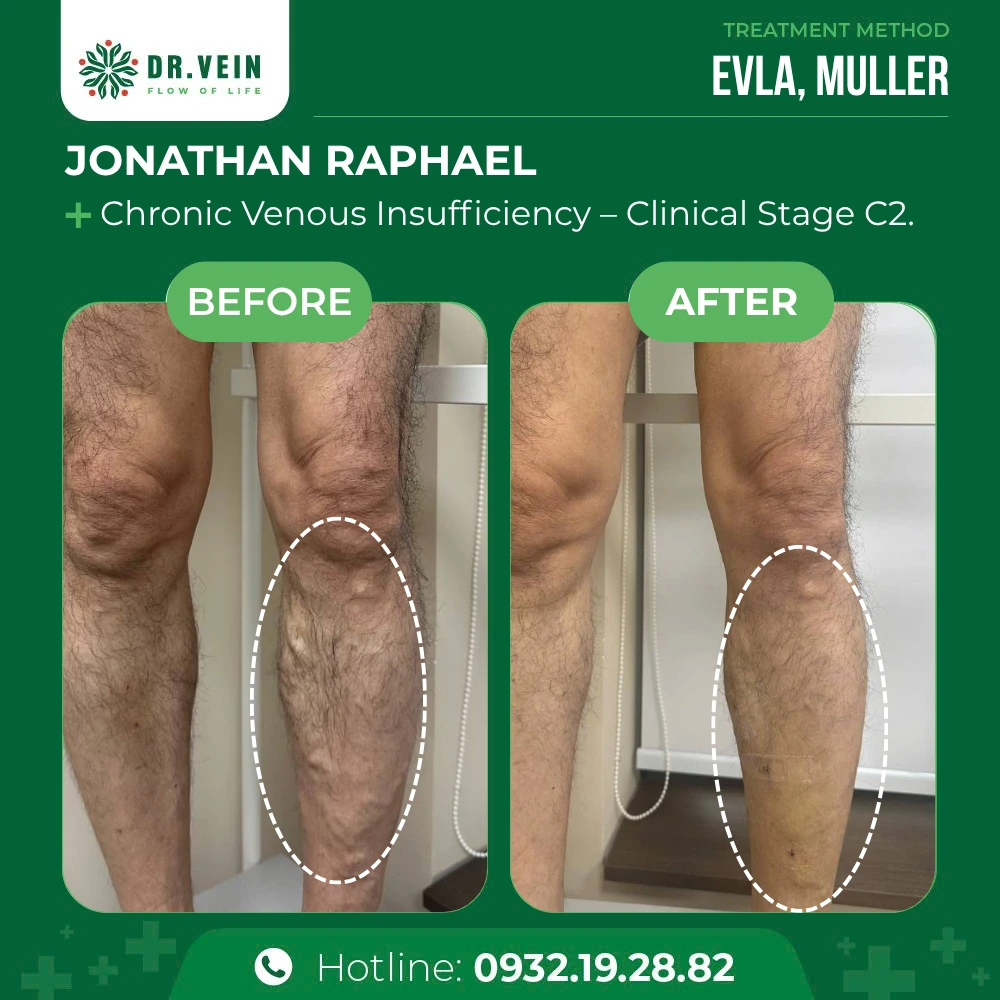 Treating Asymptomatic Bulging Varicose Veins: Jonathan Raphael’s Story At Dr. Vein