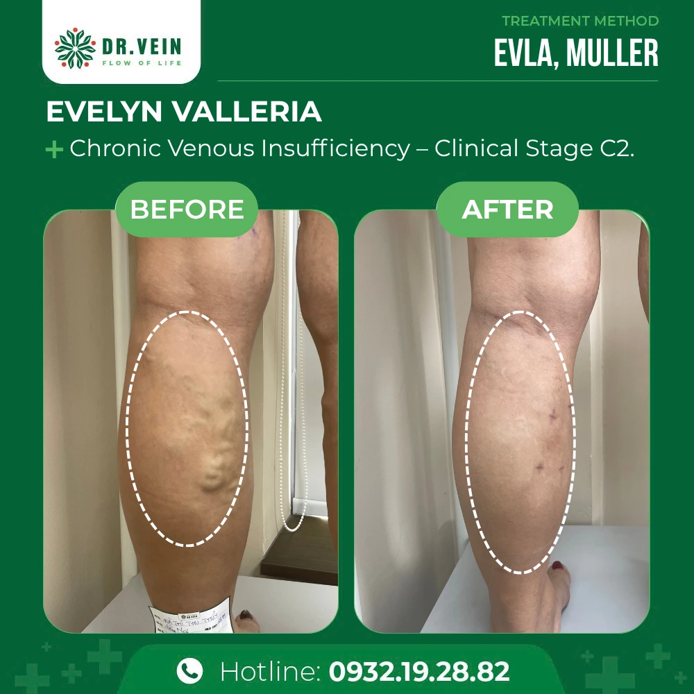 Overcoming Severe Bulging Veins And Leg Aching: Evelyn Valleria’s Treatment Journey At Dr. Vein
