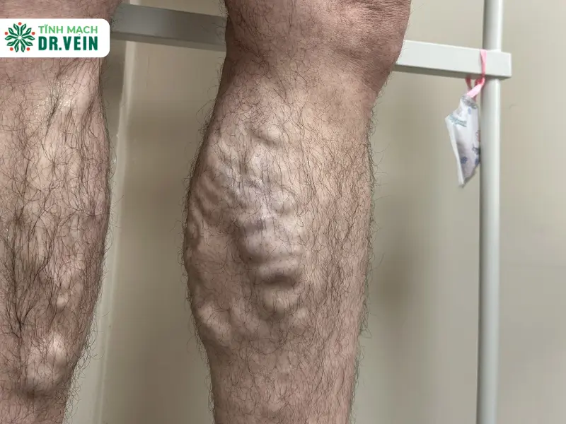 Understanding Varicose Veins: Causes, Symptoms, and Treatments 70% of patients present at stages C3–C4
