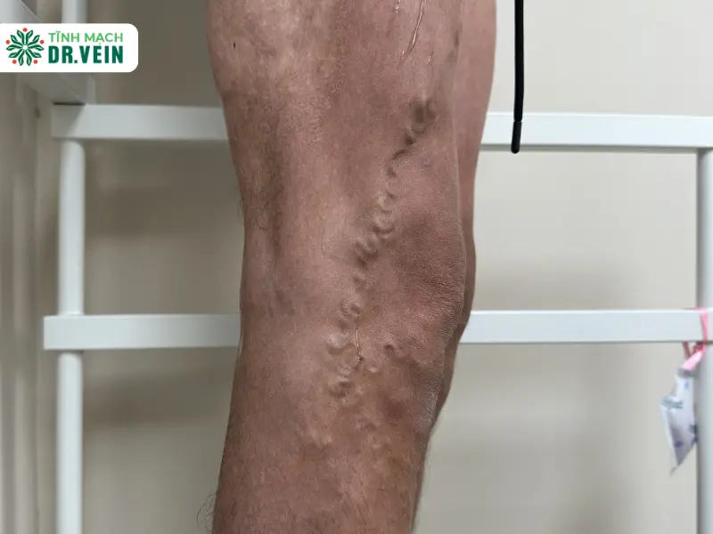 Understanding Varicose Veins: Causes, Symptoms, and Treatments Diagnosis of Chronic Venous Insufficiency