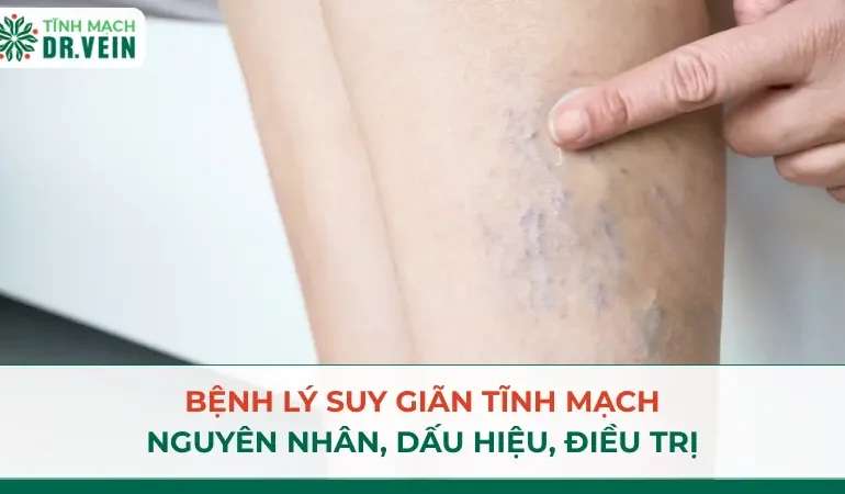 Bệnh lý suy giãn tĩnh mạch: Nguyên nhân, dấu hiệu, điều trị