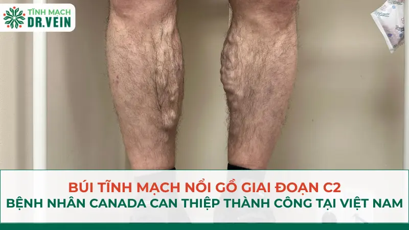 Búi Tĩnh Mạch Nổi Gồ Giai Đoạn C2: Bệnh Nhân Canada Can Thiệp Thành Công Tại Việt Nam