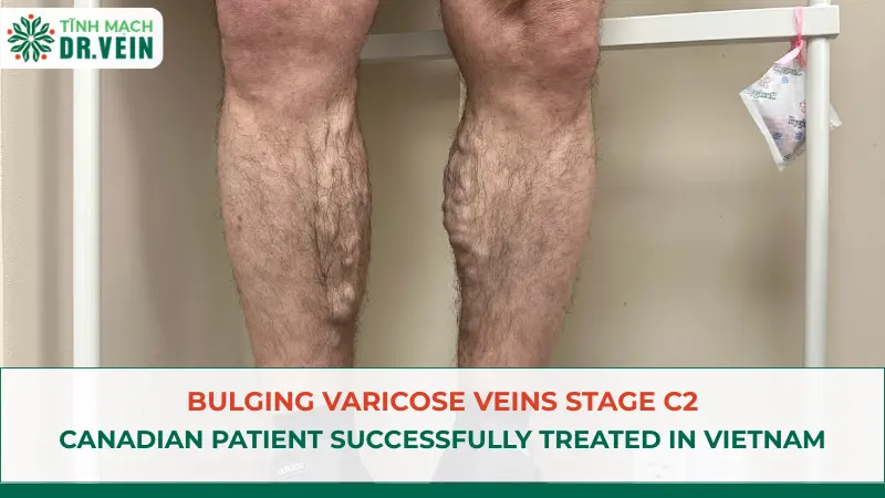 Bulging Varicose Veins Stage C2: Canadian Patient Successfully Treated In Vietnam
