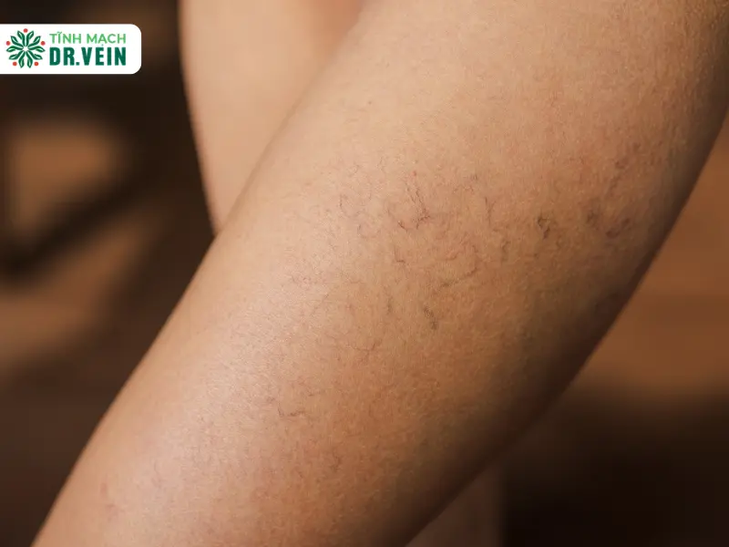 Chân nổi gân xanh là bị gì, khi nào đáng lo và xử lý thế nào? Chân nổi gân xanh là bị gì?
