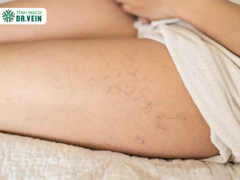 Chân nổi gân xanh là bị gì, khi nào đáng lo và xử lý thế nào? Khi nào chân nổi gân xanh là đáng lo?