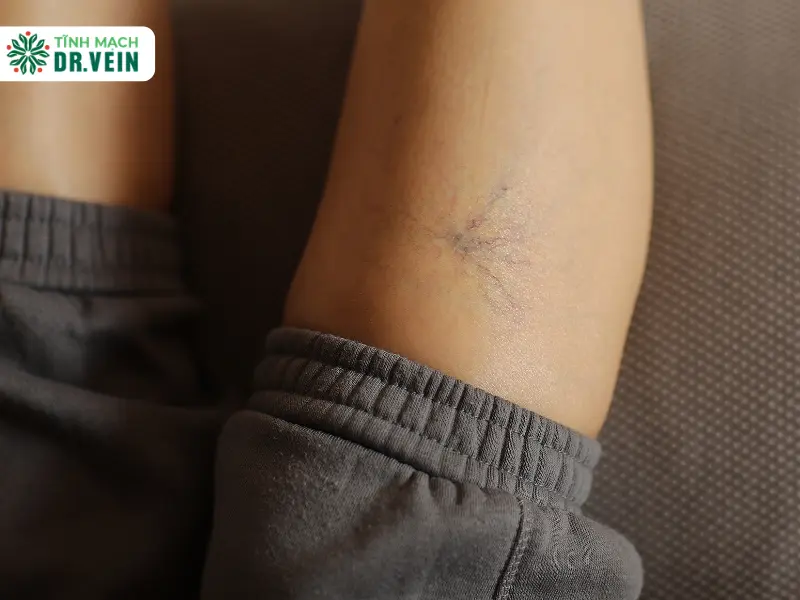 Chân nổi gân xanh là bị gì, khi nào đáng lo và xử lý thế nào? Nổi gân xanh ở chân có phải là giãn tĩnh mạch không?
