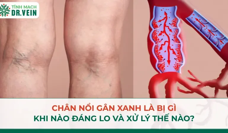 Chân nổi gân xanh là bị gì, khi nào đáng lo và xử lý thế nào?