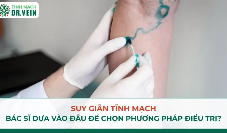 Suy giãn tĩnh mạch: bác sĩ dựa vào đâu để chọn phương pháp điều trị? Suy giãn tĩnh mạch: bác sĩ dựa vào đâu để chọn phương pháp điều trị?