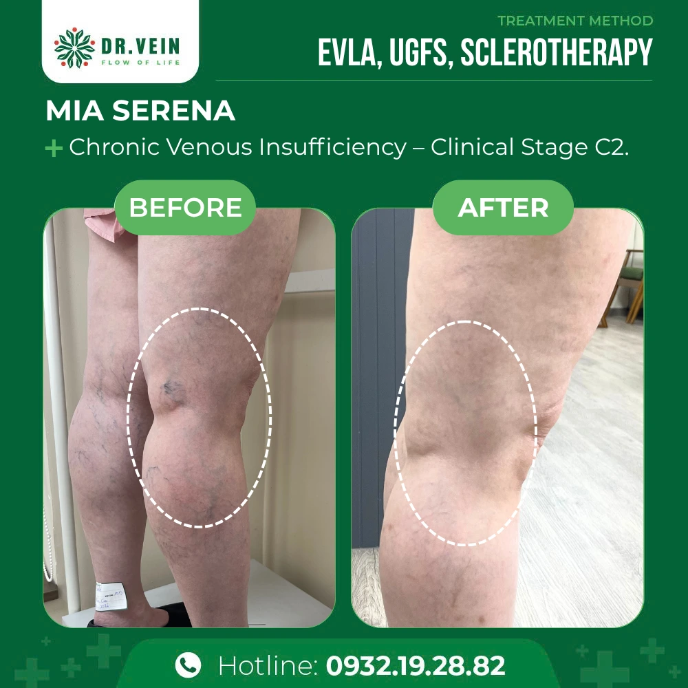 Relieving Knee Aching And Fatigue: Mia Serena’s Journey 