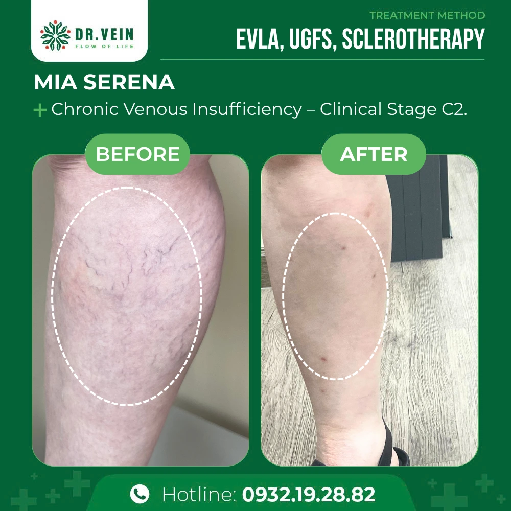 Relieving Knee Aching And Fatigue: Mia Serena’s Journey 