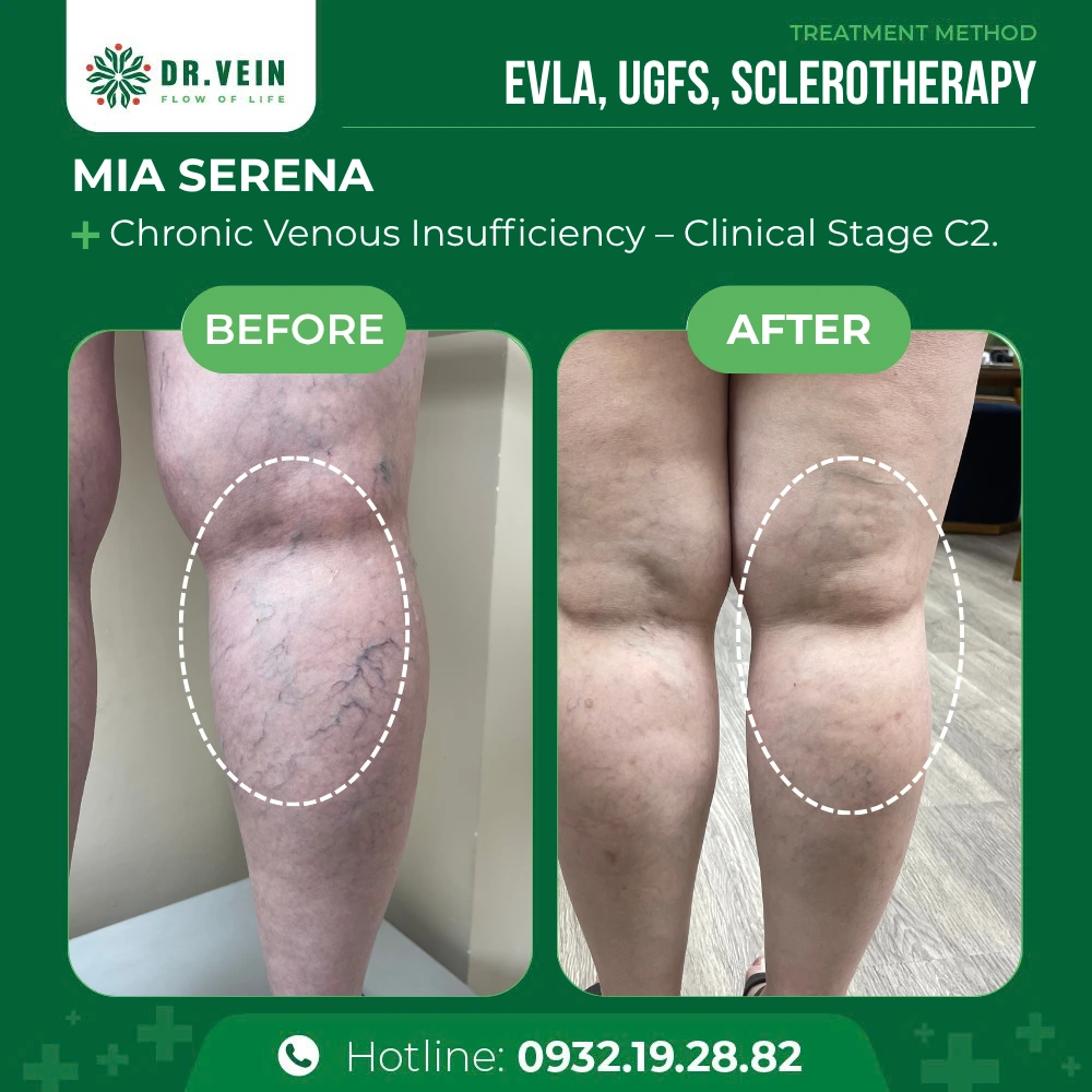 Relieving Knee Aching And Fatigue: Mia Serena’s Journey
