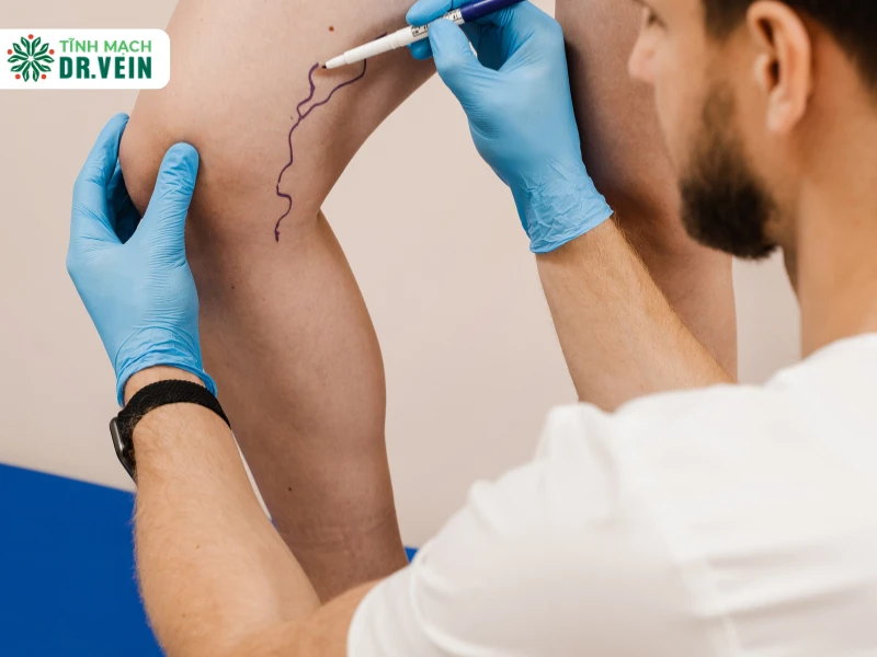 Vị trí và số lượng tĩnh mạch cần điều trị