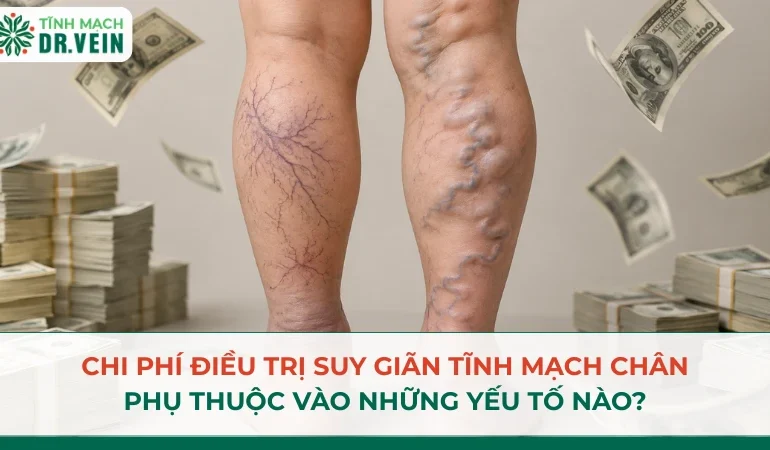 Chi phí điều trị suy giãn tĩnh mạch chân phụ thuộc vào những yếu tố nào?