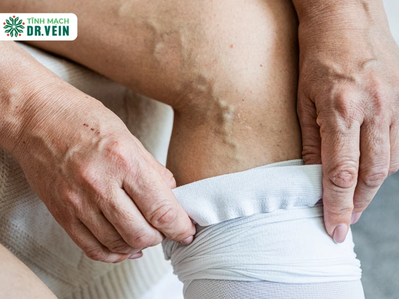 Bị giãn tĩnh mạch chân nên làm gì? Lộ trình theo từng mức độ gian tinh mach chan nen lam gi 1