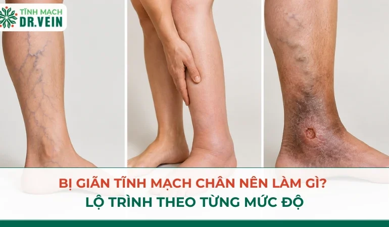Bị giãn tĩnh mạch chân nên làm gì? Lộ trình theo từng mức độ