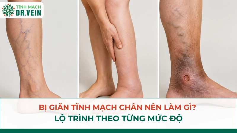 Bị giãn tĩnh mạch chân nên làm gì? Lộ trình theo từng mức độ