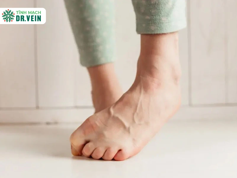 Giãn tĩnh mạch ở trẻ em và thanh thiếu niên: khi nào là bình thường, khi nào cần khám chuyên khoa Giãn tĩnh mạch ở trẻ em