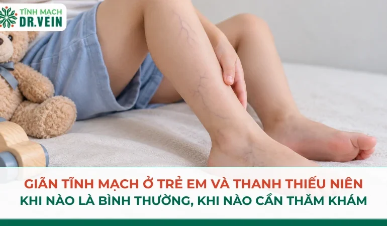 Giãn tĩnh mạch ở trẻ em và thanh thiếu niên: khi nào là bình thường, khi nào cần khám chuyên khoa